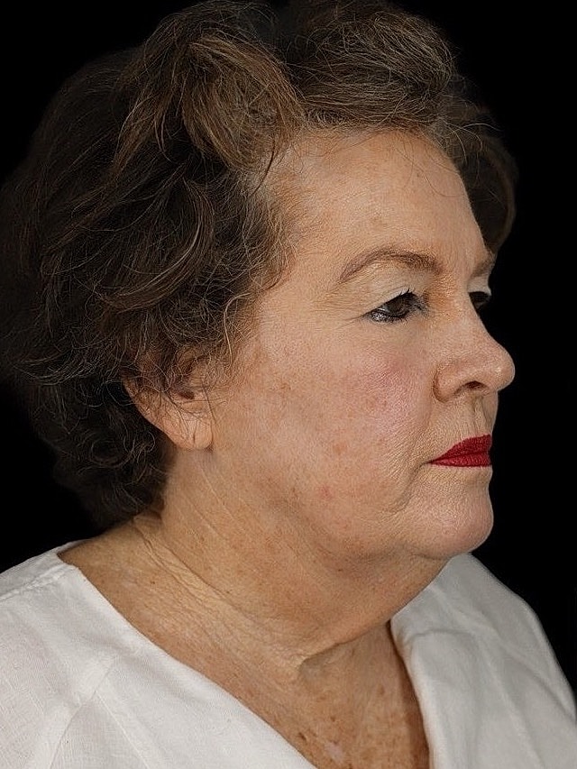 Deep Plane Facelift Gallery Before & After