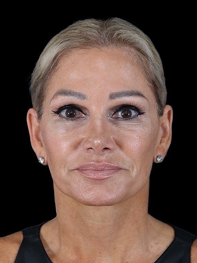 Deep Plane Facelift Gallery Before & After
