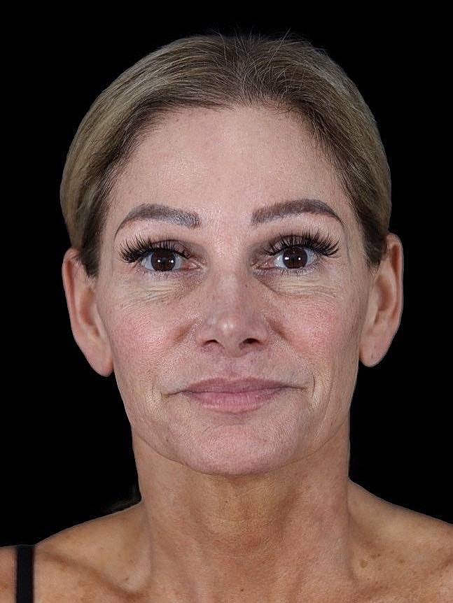 Deep Plane Facelift Gallery Before & After