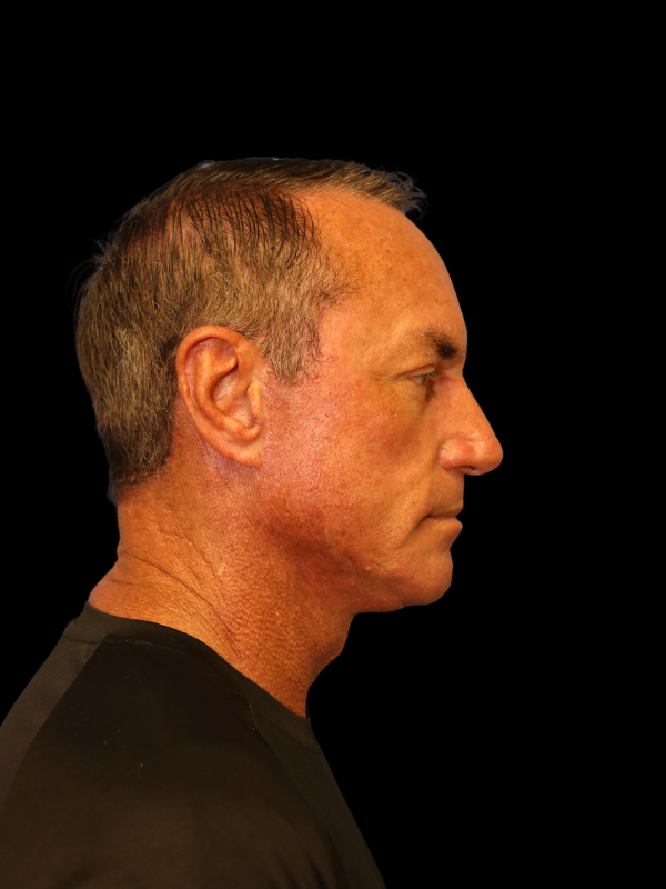 Deep Plane Facelift Gallery Before & After