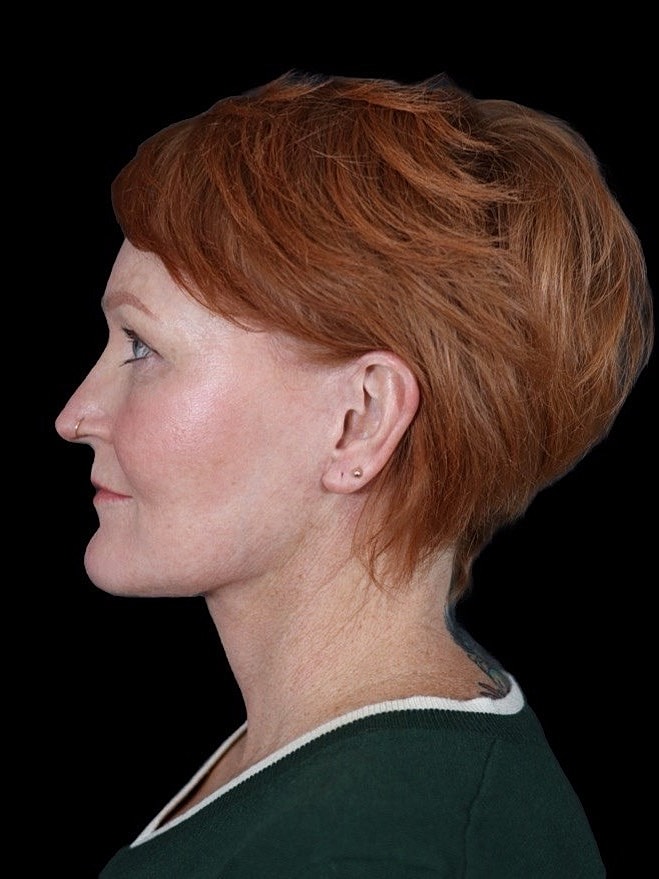 Deep Plane Facelift Gallery Before & After