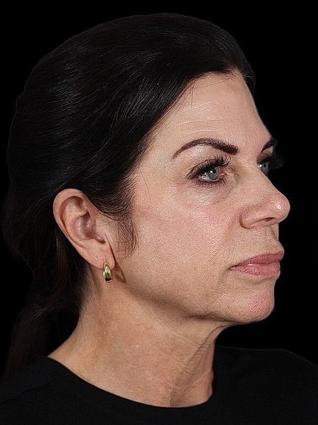 Deep Plane Facelift Gallery Before & After