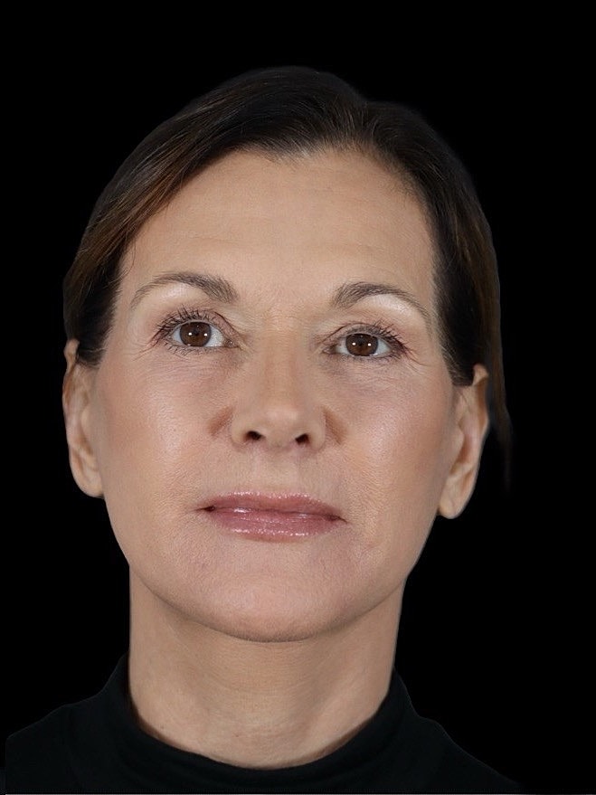 Deep Plane Facelift Gallery Before & After