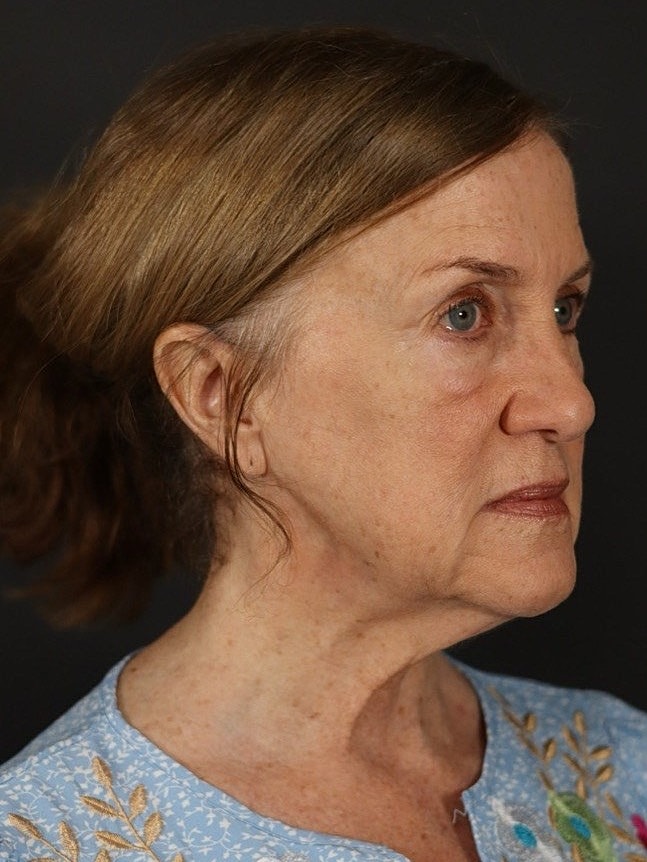 Deep Plane Facelift Gallery Before & After