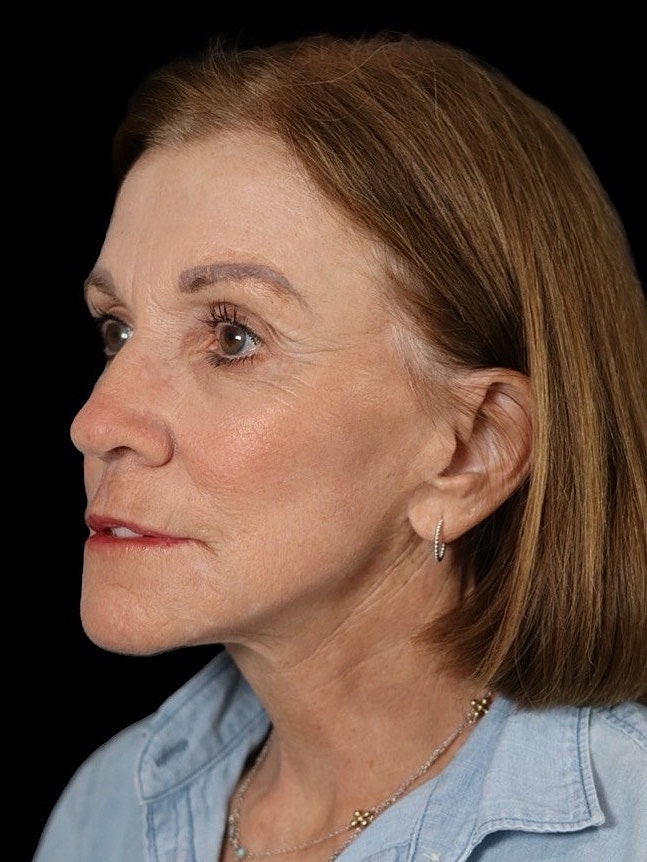 Deep Plane Facelift Gallery Before & After