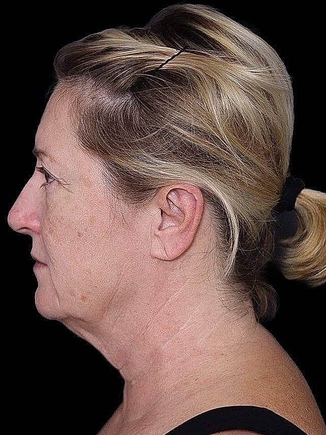 Deep Plane Facelift Gallery Before & After