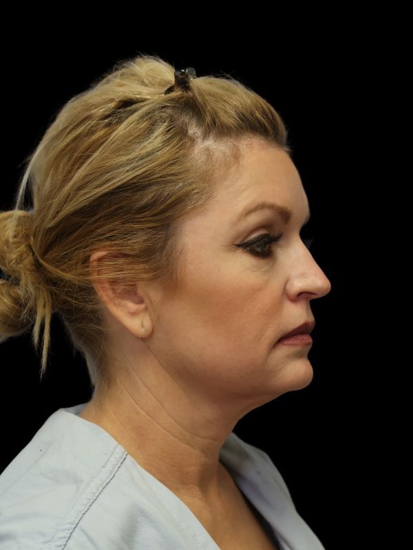 Deep Plane Facelift Gallery Before & After