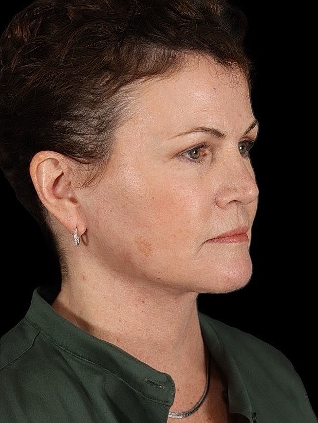 Deep Plane Facelift Gallery Before & After