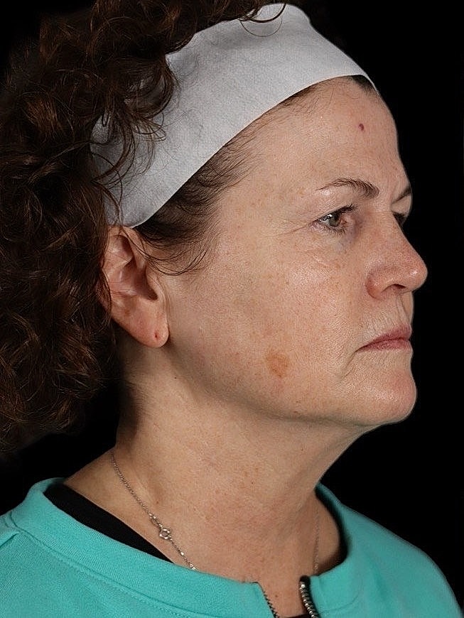 Deep Plane Facelift Gallery Before & After