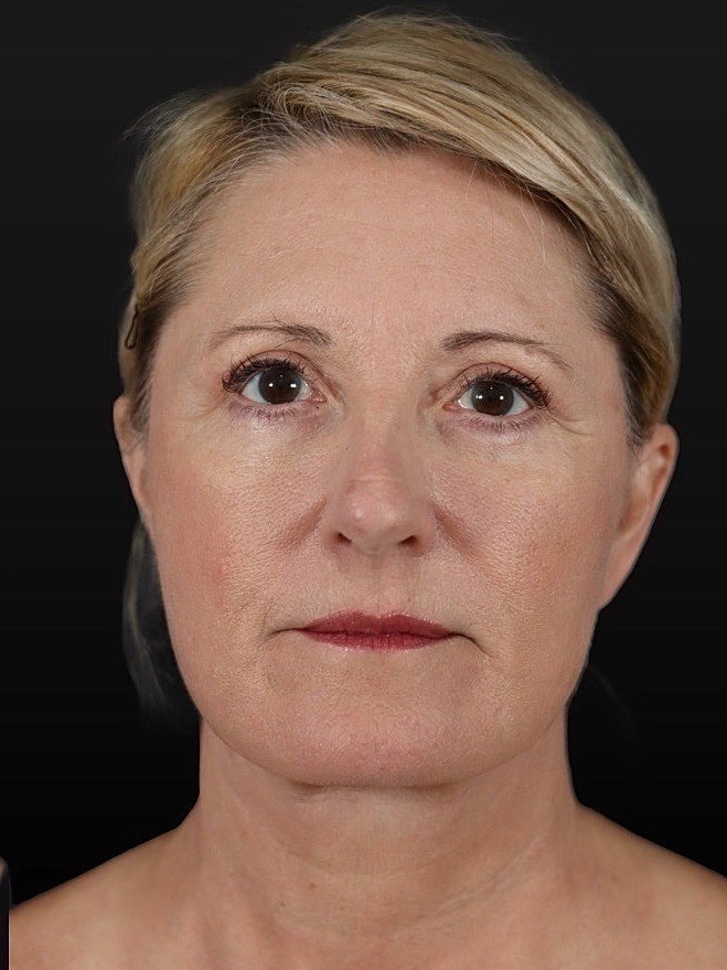 Deep Plane Facelift Gallery Before & After