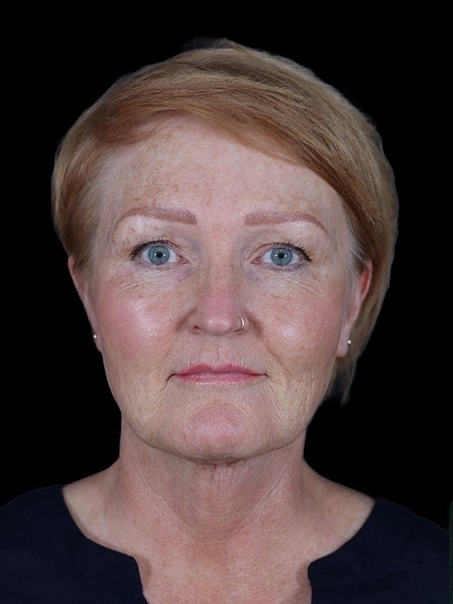 Deep Plane Facelift Gallery Before & After