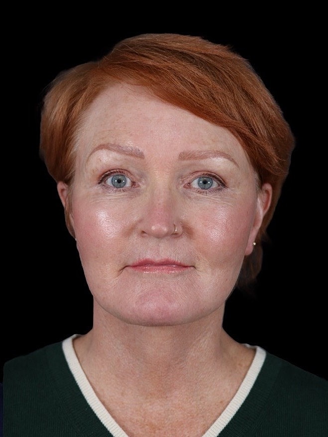 Deep Plane Facelift Gallery Before & After