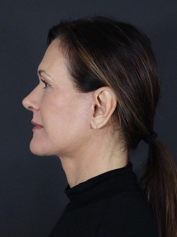 Deep Plane Facelift Gallery Before & After