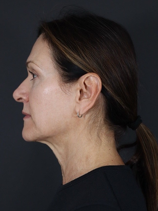 Deep Plane Facelift Gallery Before & After