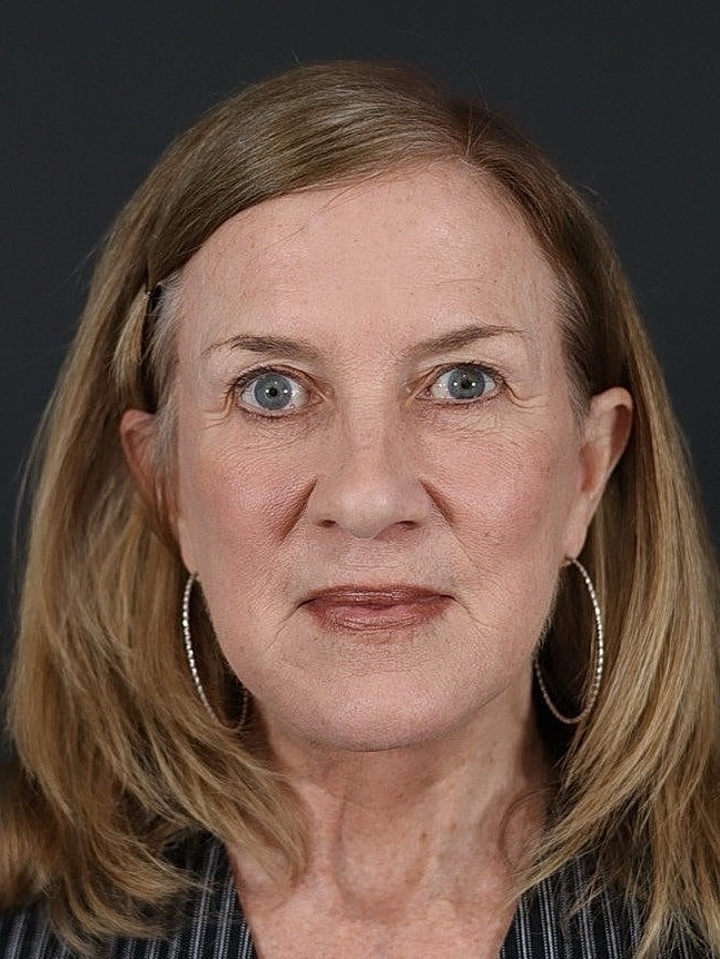 Deep Plane Facelift Gallery Before & After