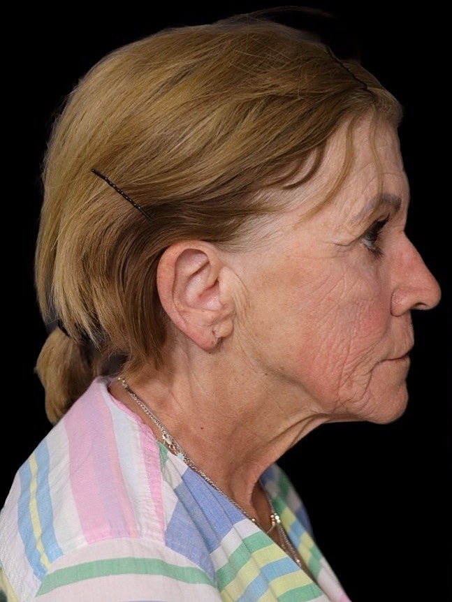 Deep Plane Facelift Gallery Before & After