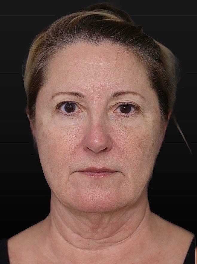 Deep Plane Facelift Gallery Before & After