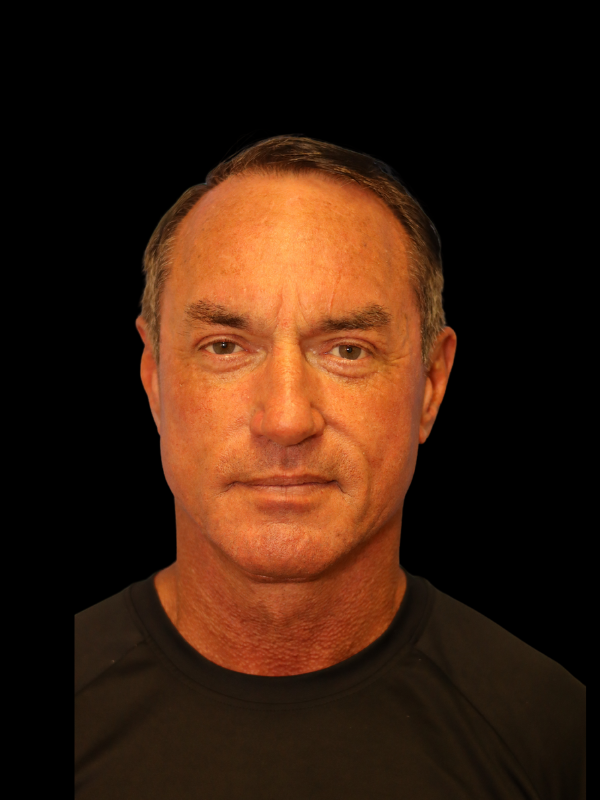 Deep Plane Facelift Gallery Before & After