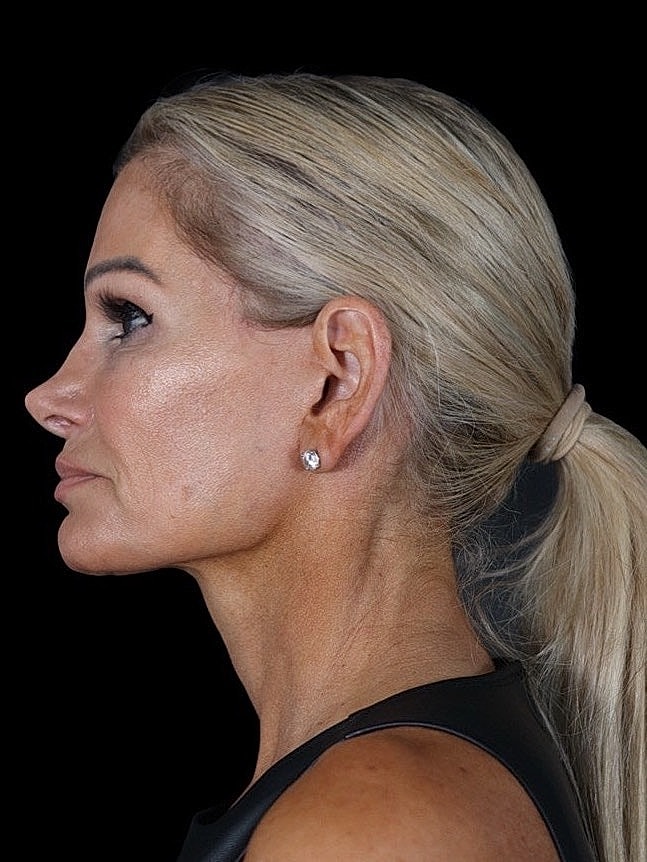 Deep Plane Facelift Gallery Before & After