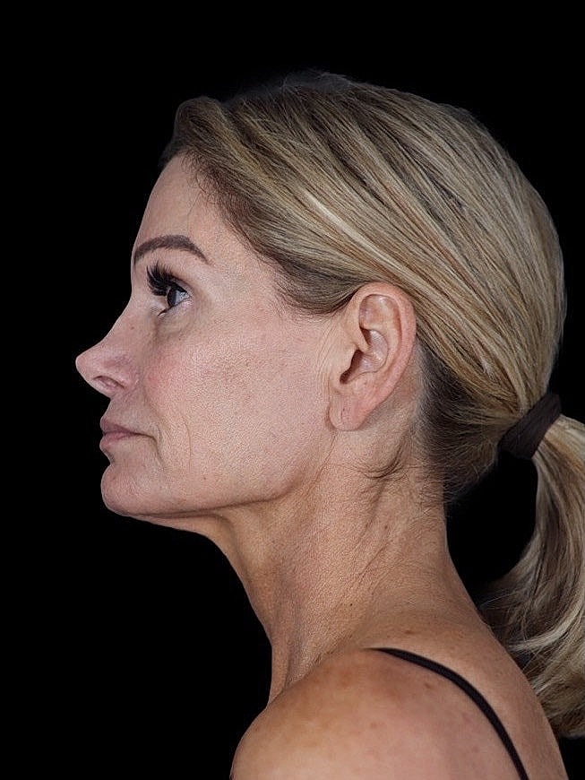 Deep Plane Facelift Gallery Before & After
