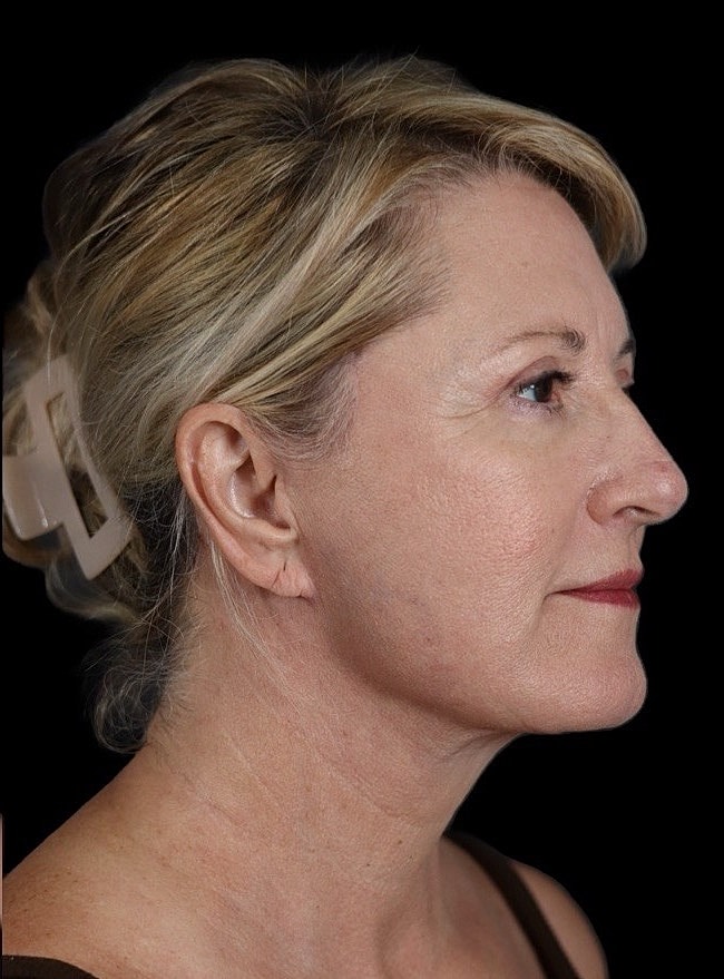 Deep Plane Facelift Gallery Before & After