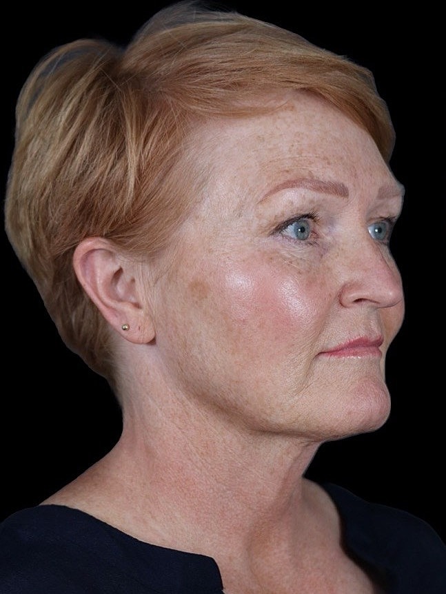 Deep Plane Facelift Gallery Before & After