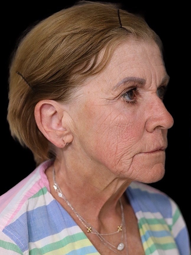 Deep Plane Facelift Gallery Before & After