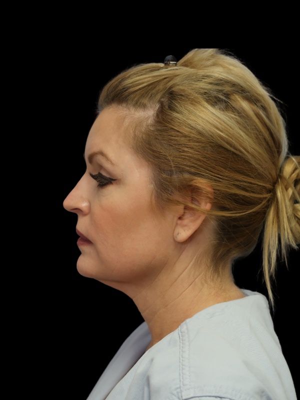 Deep Plane Facelift Gallery Before & After