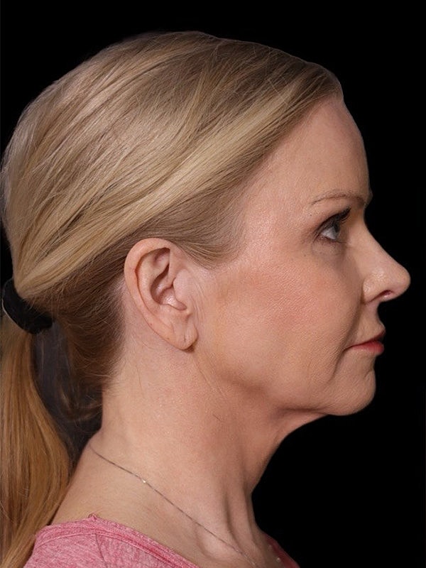 Deep Plane Facelift Gallery Before & After