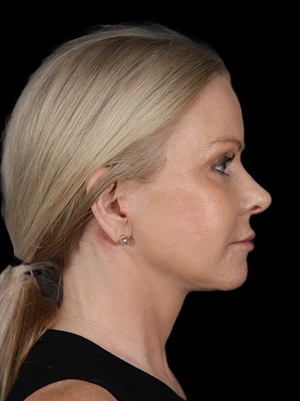 Deep Plane Facelift Gallery Before & After