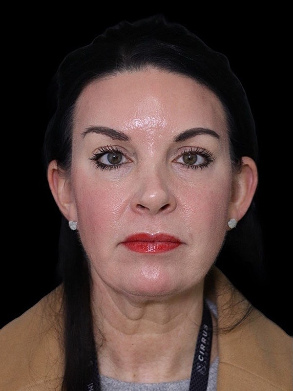 Deep Plane Facelift Gallery Before & After