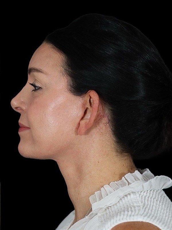 Deep Plane Facelift Gallery Before & After