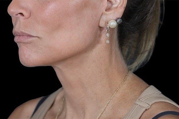 Deep Plane Facelift Gallery Before & After