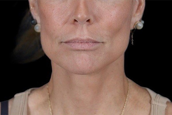 Deep Plane Facelift Gallery Before & After