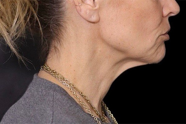 Deep Plane Facelift Gallery Before & After