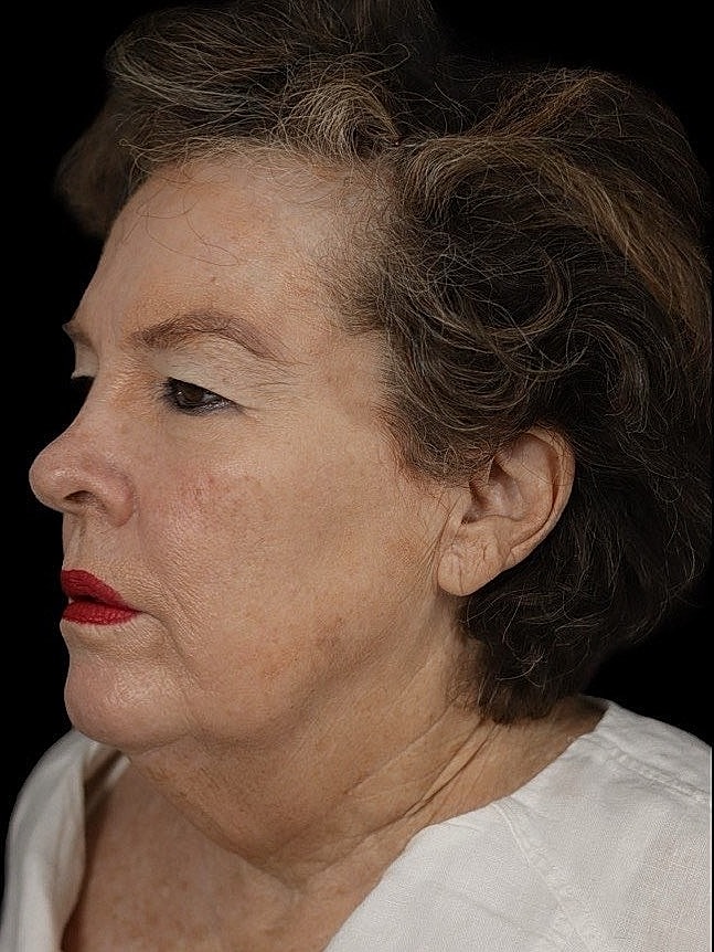 Deep Plane Facelift Gallery Before & After