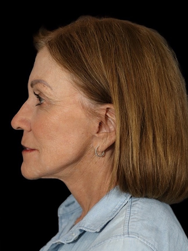 Deep Plane Facelift Gallery Before & After