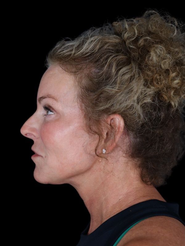 Deep Plane Facelift Gallery Before & After