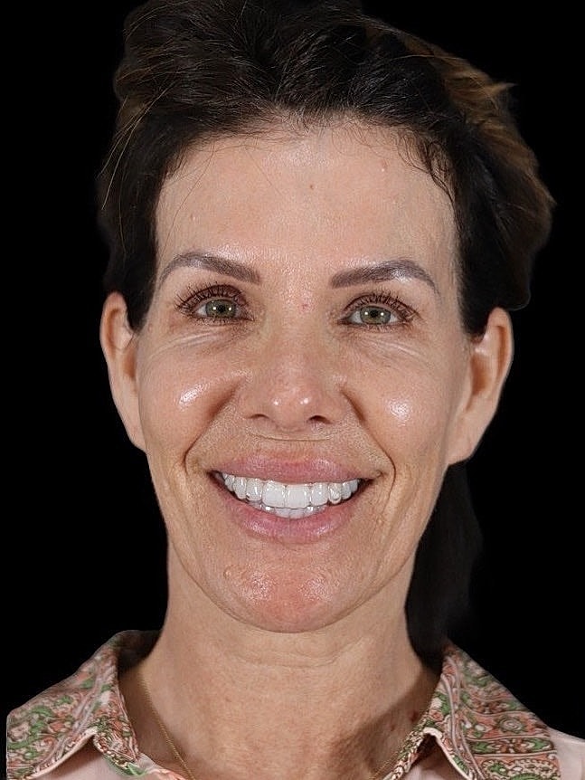 Deep Plane Facelift Gallery Before & After
