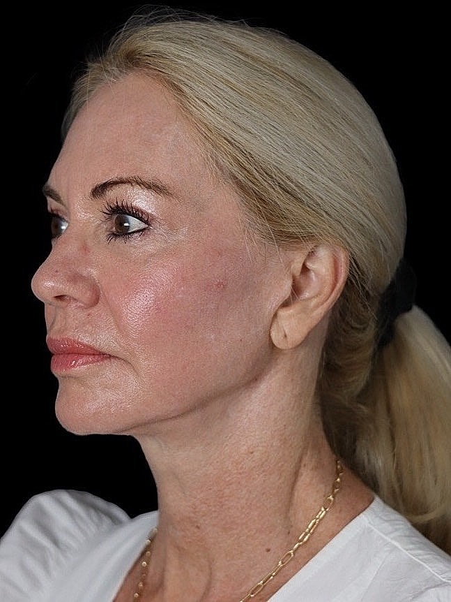 Deep Plane Facelift Gallery Before & After
