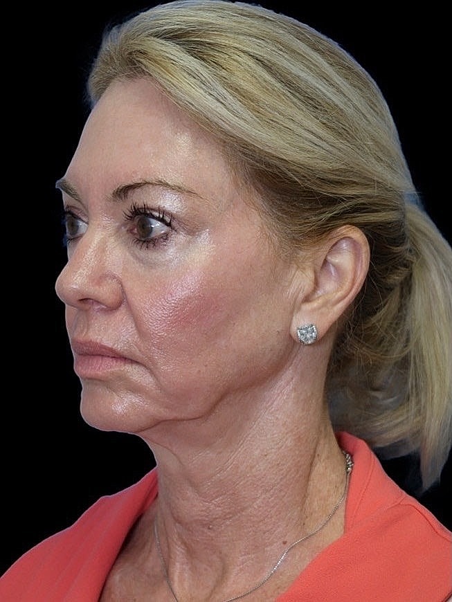 Deep Plane Facelift Gallery Before & After