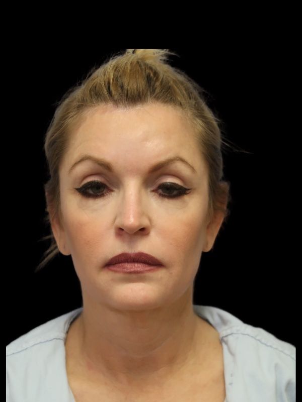 Deep Plane Facelift Gallery Before & After