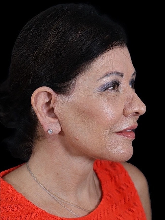 Deep Plane Facelift Gallery Before & After