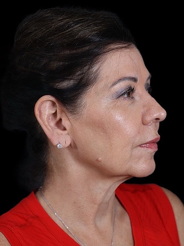 Deep Plane Facelift Gallery Before & After