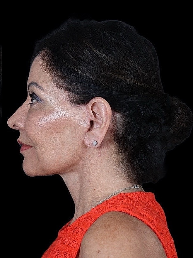 Deep Plane Facelift Gallery Before & After