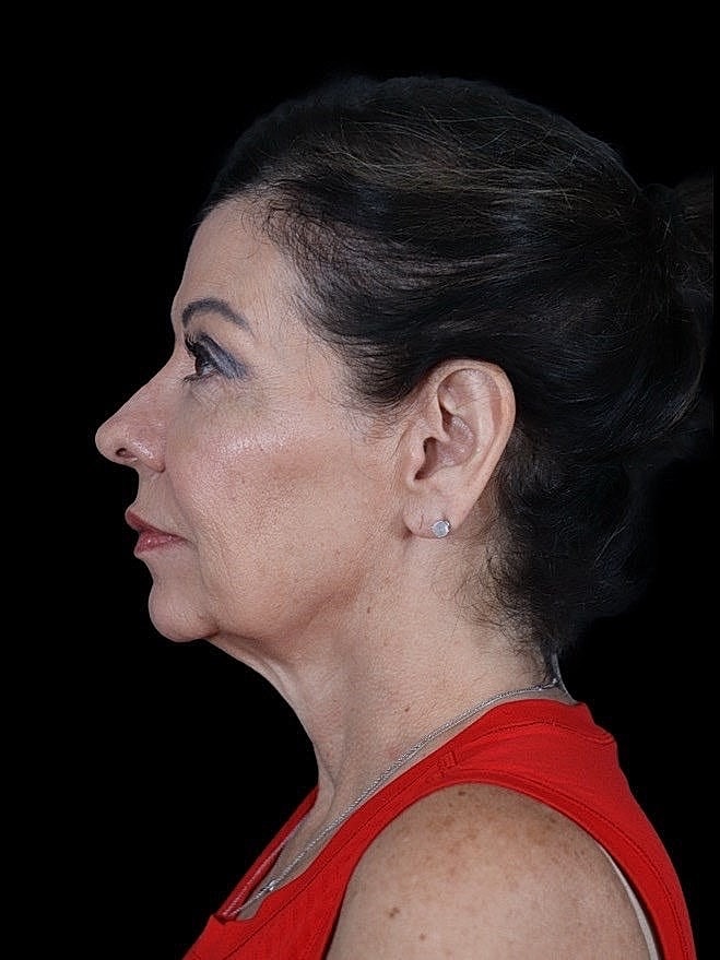 Deep Plane Facelift Gallery Before & After