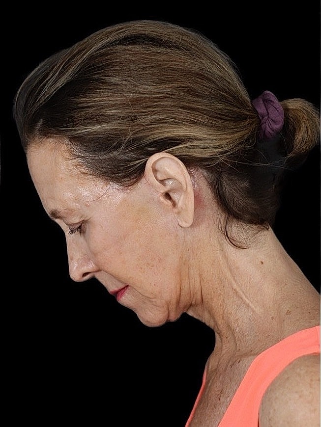 Deep Plane Facelift Gallery Before & After