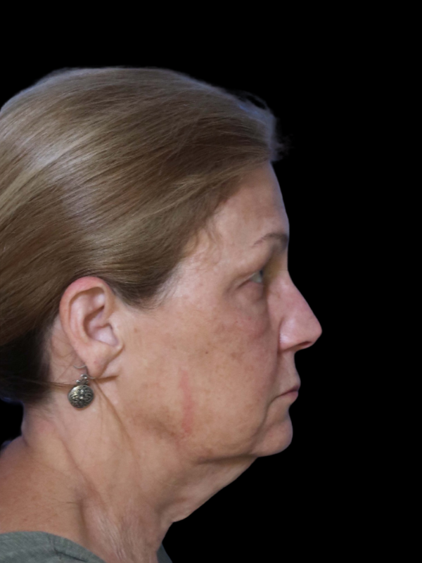 Deep Plane Facelift Gallery Before & After