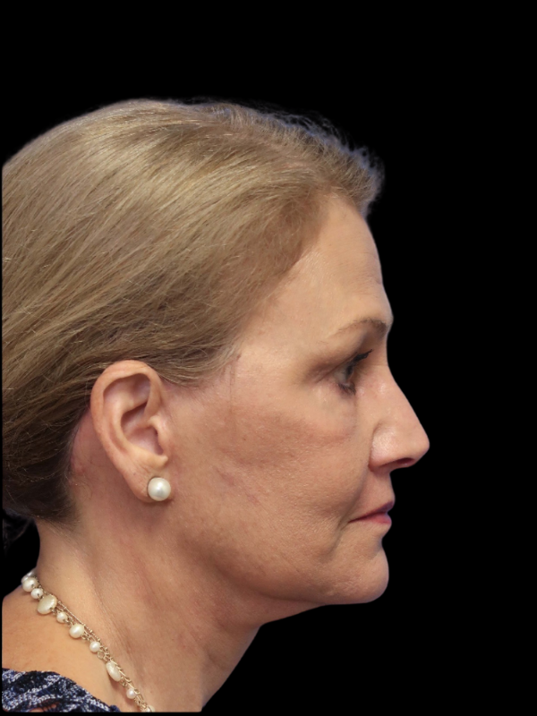 Deep Plane Facelift Gallery Before & After