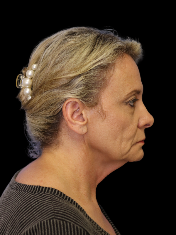 Deep Plane Facelift Gallery Before & After